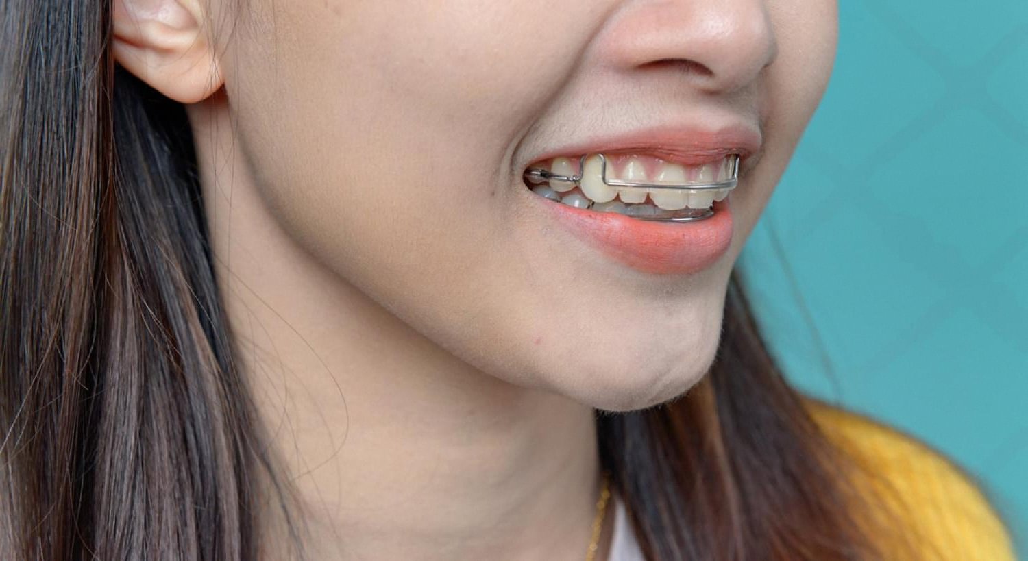 Close-up of a young woman smiling while wearing dental braces
